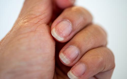 Close up of brittle fingernails.